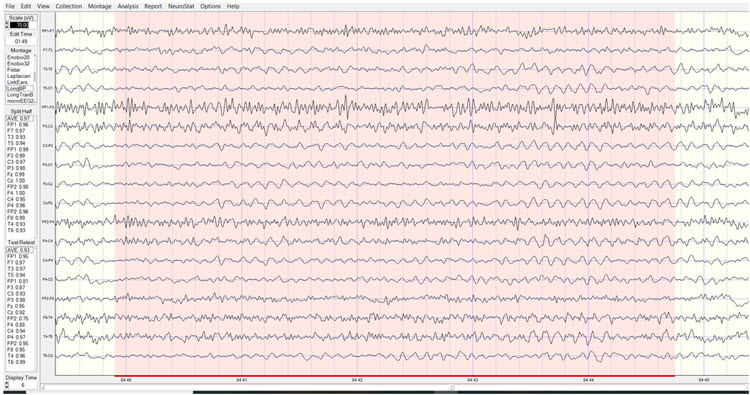 Longitudinal bipolar montage eyes-closed pre-training baseline showing symmetric alpha and excess beta